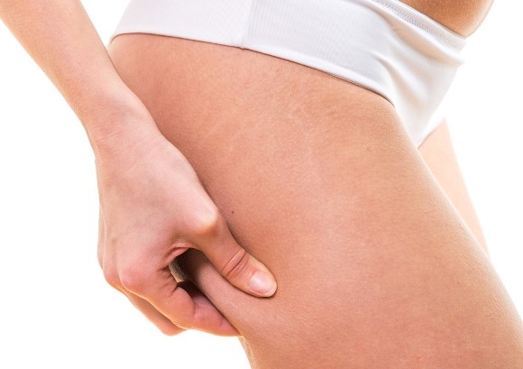10 mitos comunes sobre celulitis