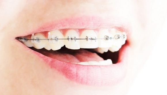 ¿Quieres saber si necesitas ortodoncia?