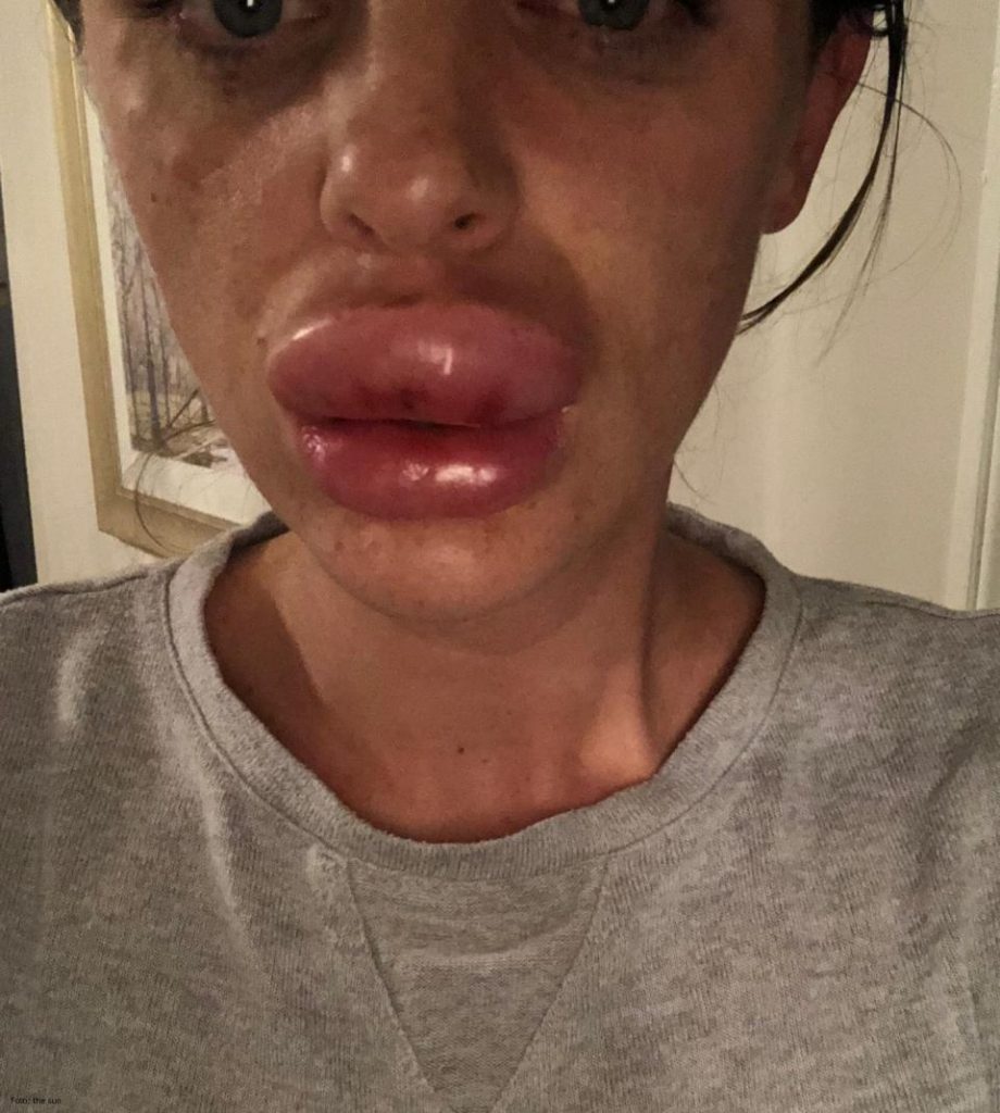 mujer después de la aplicarse botox