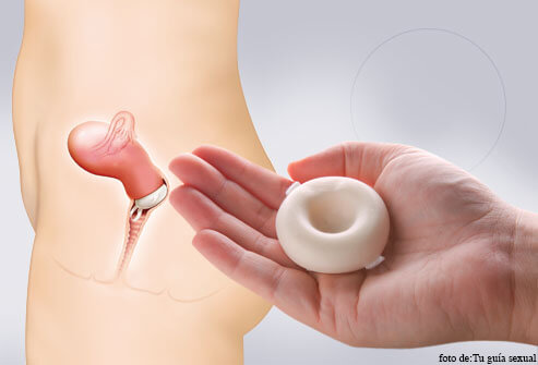 esponja, métodos anticonceptivos de barrera