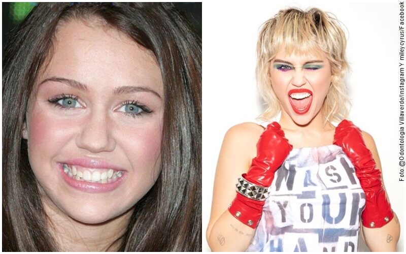 Antes y después del diseño de sonrisa de Miley Cirus