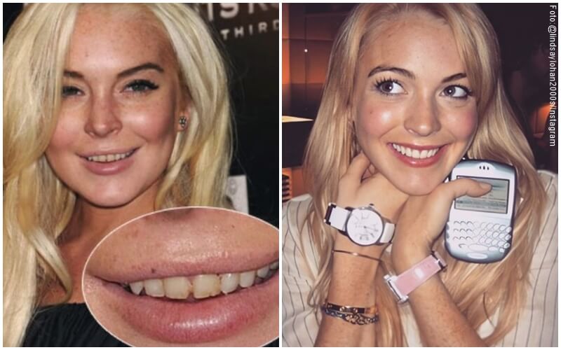 Antes y después del diseño de sonrisa de Lindsay Lohan