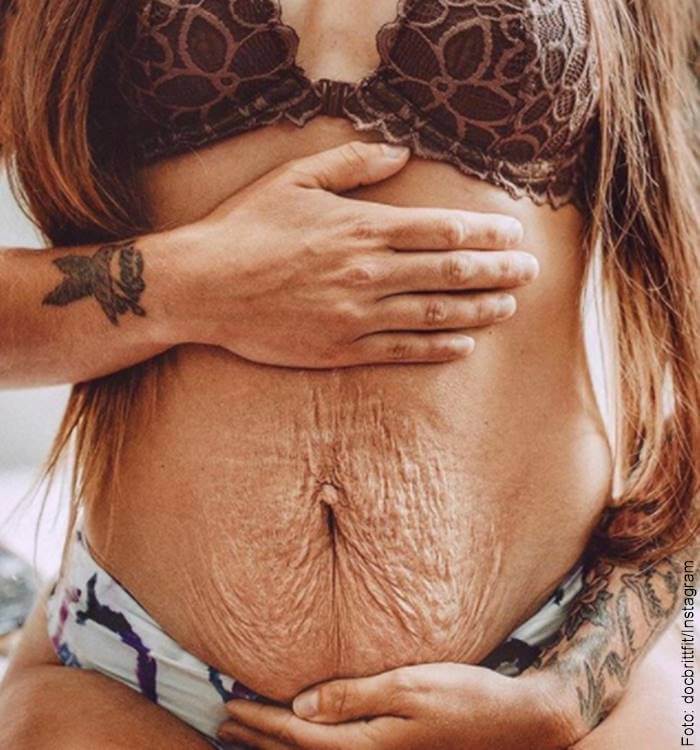 Foto de abdomen arrugado después del embarazo enorgullece a estas mamás