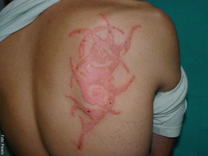 Foto de la espalda de una mujer con un tatuaje mal cuidado