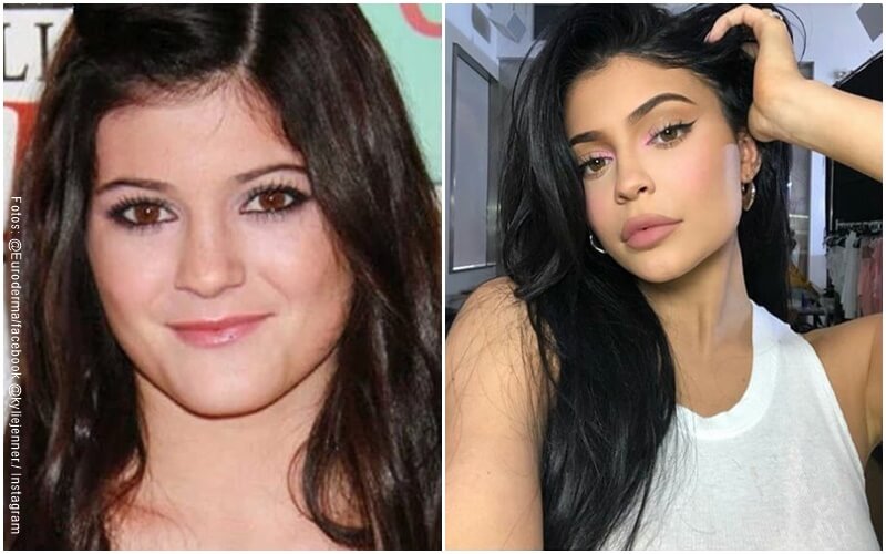 Fotos de Kylie Jenner antes y después de operarse los labios