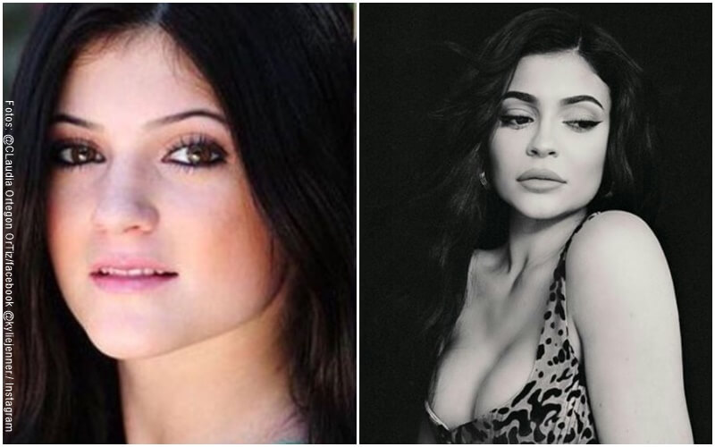 Fotos de Kylie Jenner antes y después de Arreglarse el mentón