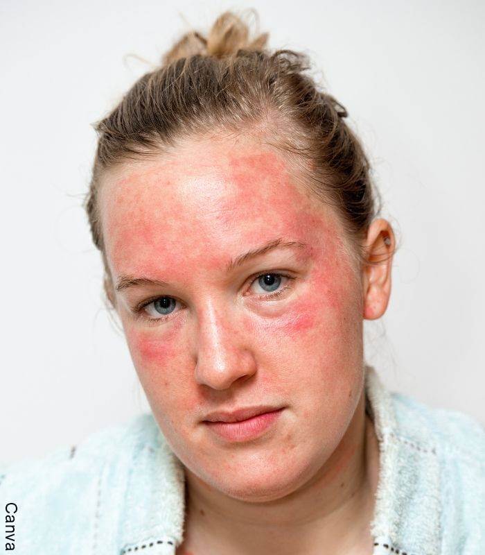 Foto de una mujer con alergia en la cara