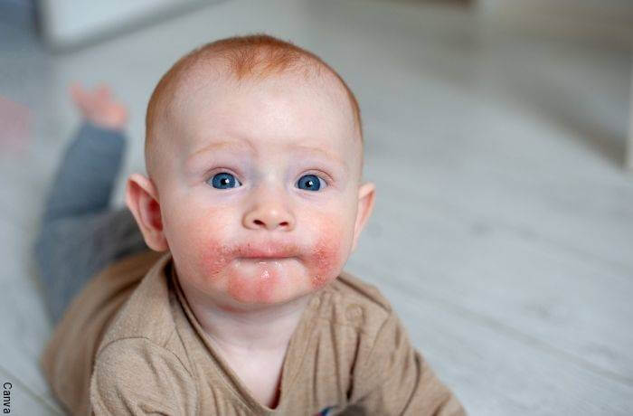 Foto de un bebé con alergia en la piel