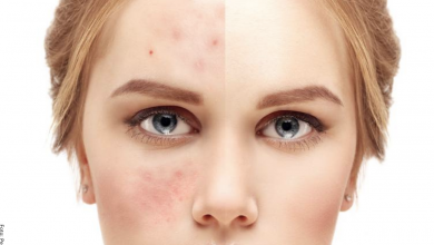 ¿Qué sirve para el acné? Remedios efectivos y naturales