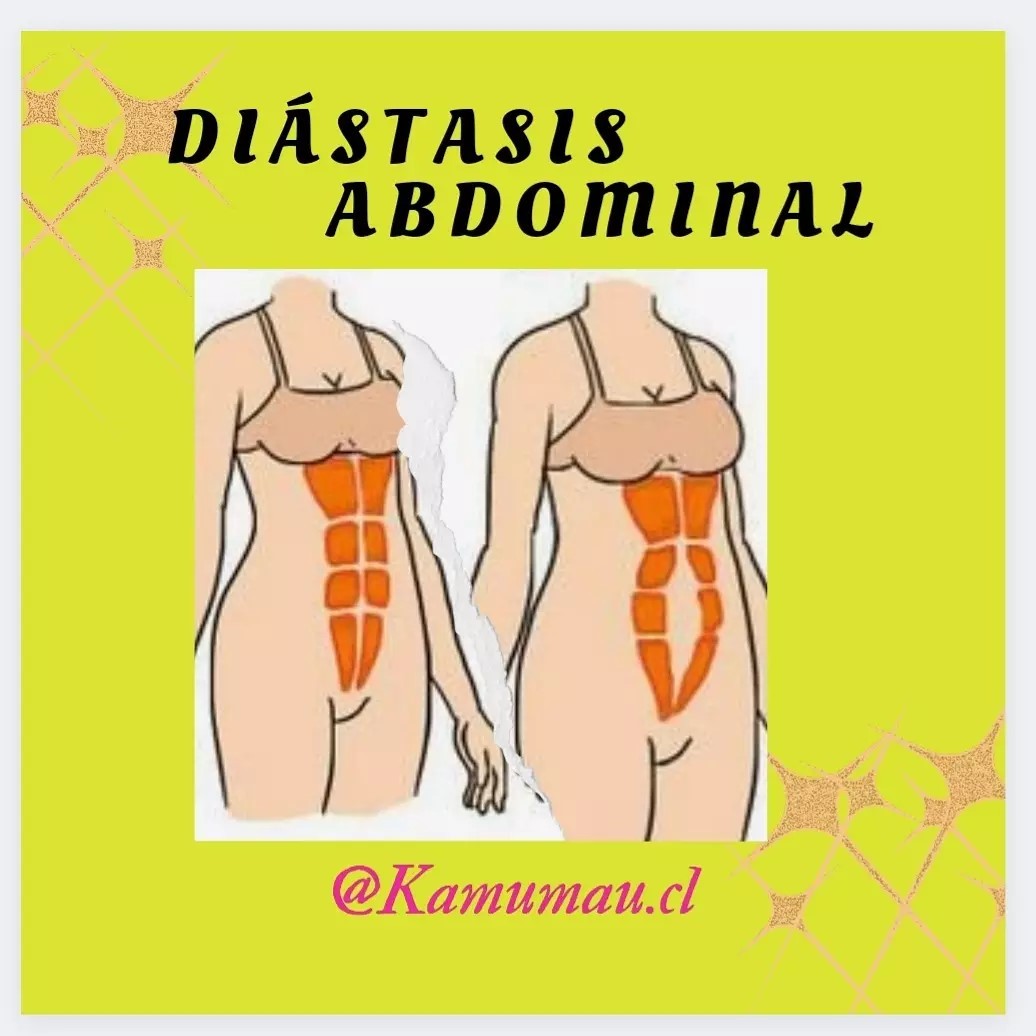 Ilustración de la diástasis abdominal