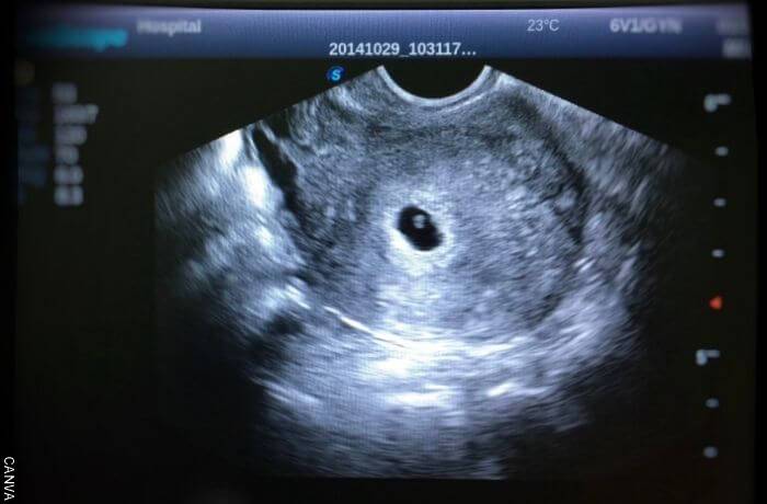 Foto de una ecografía de embarazo