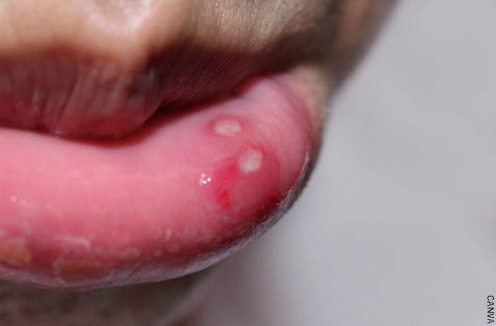 Foto de una boca con granos en los labios