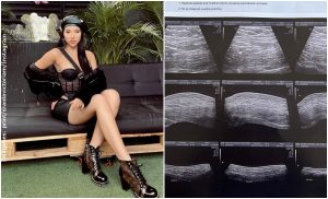 Aída Victoria Merlano demostró que no tiene biopolímeros en los glúteos