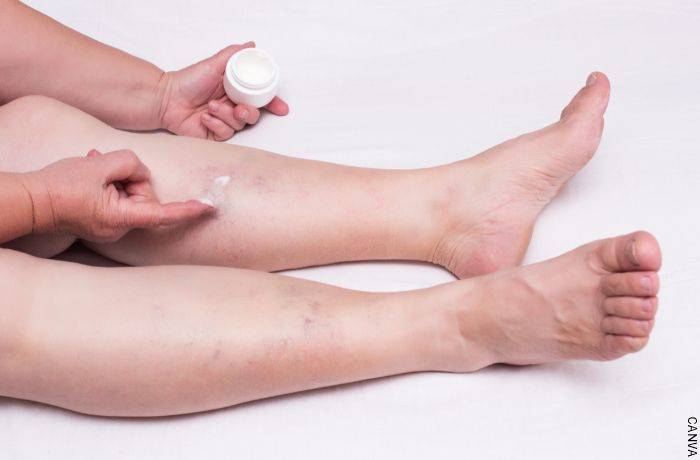 Foto de una persona aplicándose crema en las piernas