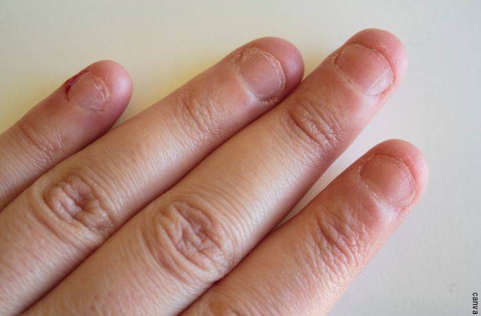 Foto de mano con uñas demasiado cortas para ilustrar soñar que se caen las uñas