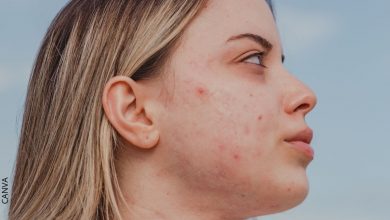 ¿Cómo quitar las cicatrices del acné? Varios tratamientos