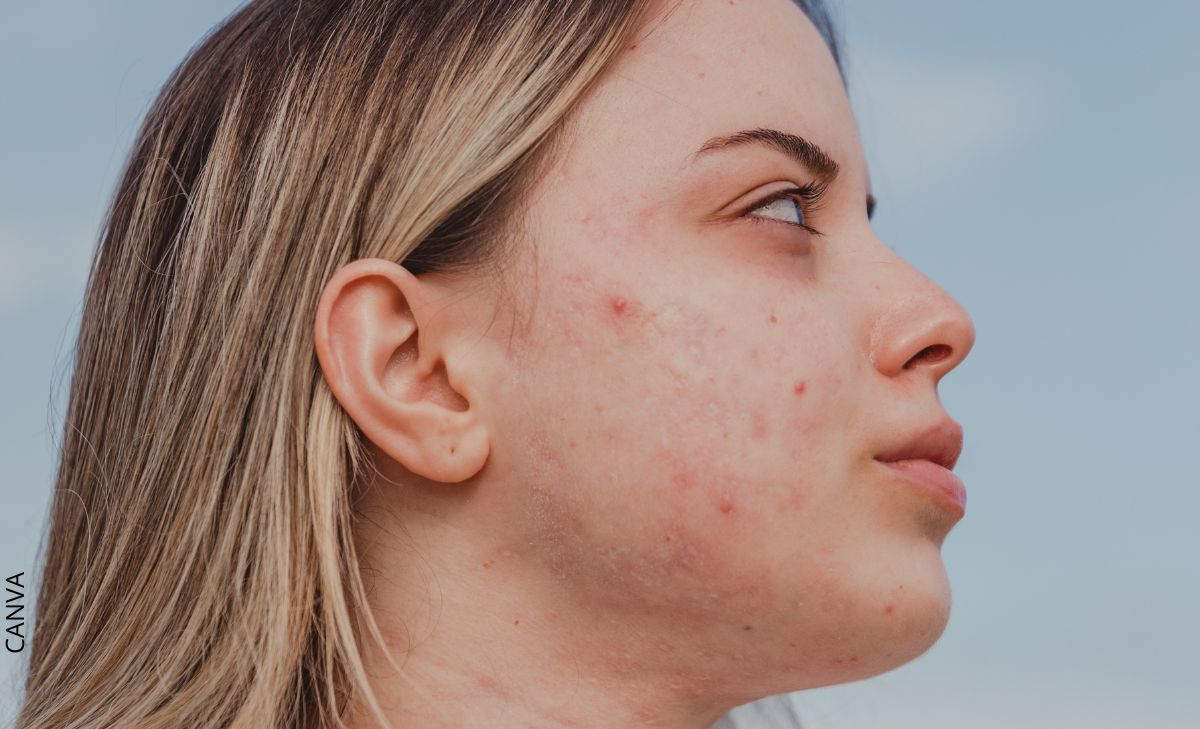 ¿Cómo quitar las cicatrices del acné? Varios tratamientos