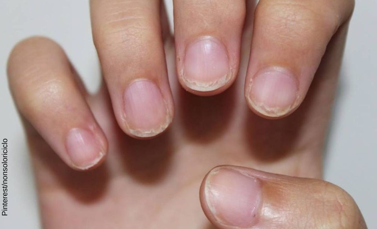 Enfermedades y trastornos de las uñas más comunes