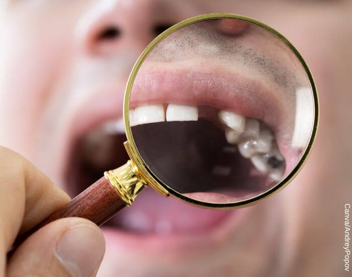 Foto de una lupa ampliando la boca de un hombre sin un diente delantero