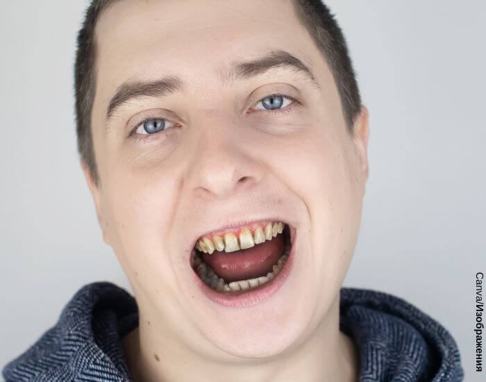 Foto de una persona con la boca abierta mostrando sus dientes negro podridos en representación de lo que significa soñar con dientes