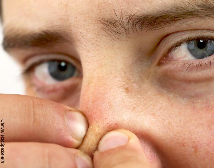 Foto de un hombre sacando las espinillas de su nariz con los dedos mientras mira a la cámara