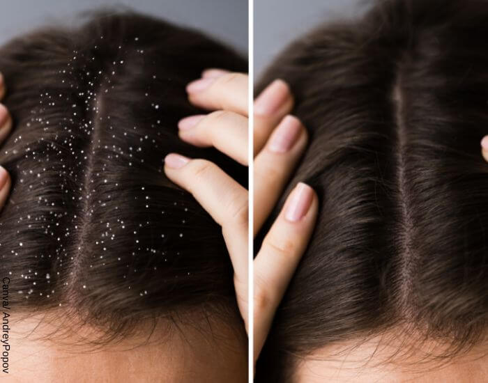 Foto del antes y después de la cabeza de una mujer de cabello oscuro luego de probar los remedios caseros para la caspa