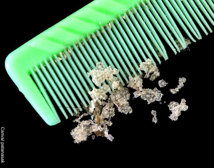 Foto de una peinilla con escamas del cuero cabelludo también conocidas como caspa