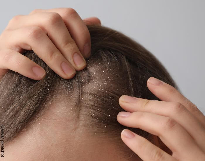 Foto de la cabeza de una persona de pelo castaño con caspa en representación de los remedios caseros para la caspa