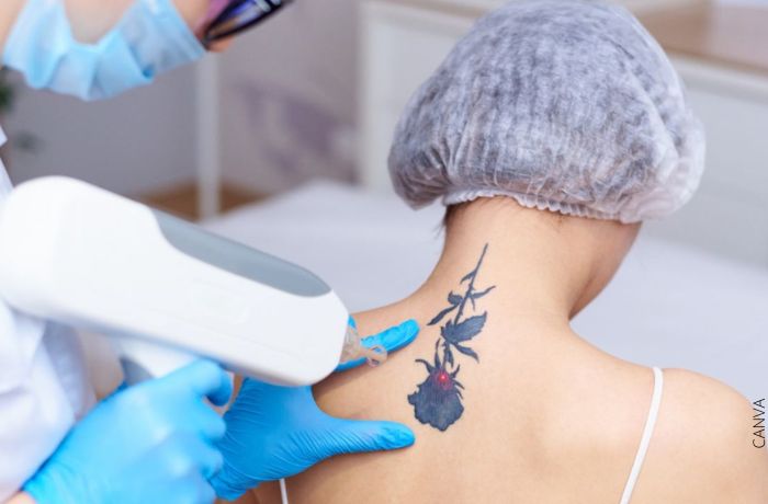 Foto de una mujer recibiendo una sesión láser en un tatuaje de la espalda