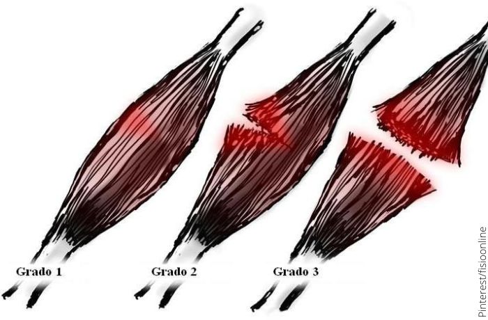 Ilustración de los tipos de desgarro muscular
