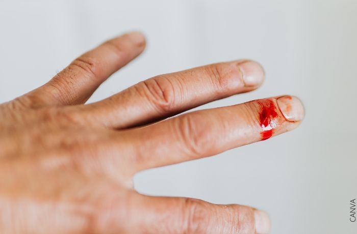 Foto de una herida en un dedo