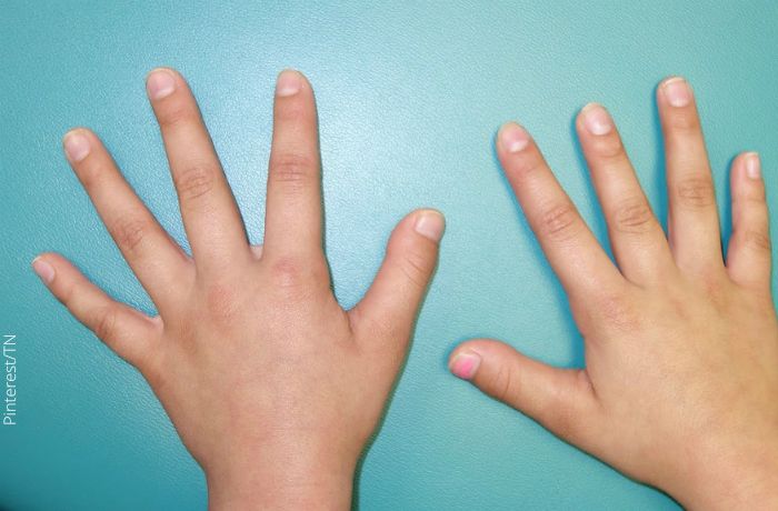 Foto de unas manos con un dedo pulgar más corto