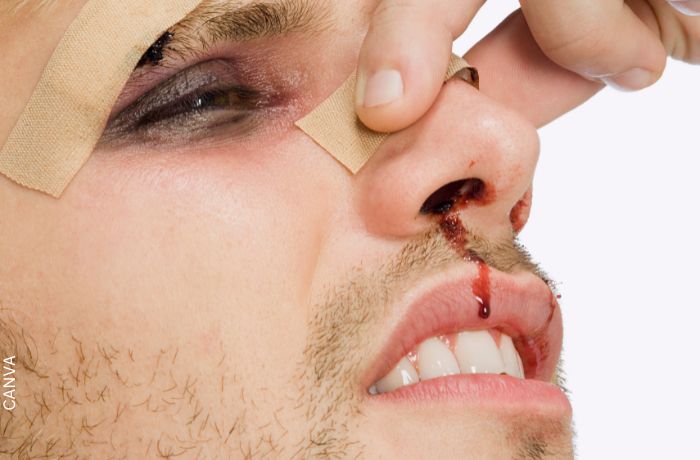 Foto de un hombre con la nariz sangrando