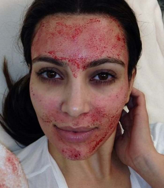 Imagen de Kim Kardashian con el tratamiento vampiro  