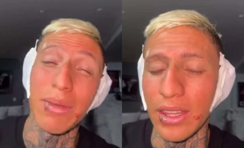 La Liendra reveló la verdad de sus heridas
