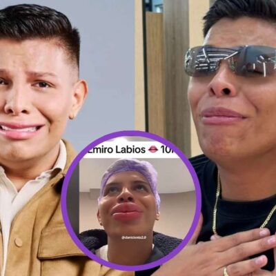 video de Emiro Navarro cuando se hizo procedimiento estético en los labios